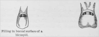Filling in buccal surface of a bicuspid Filling in buccal surface of a bicuspid